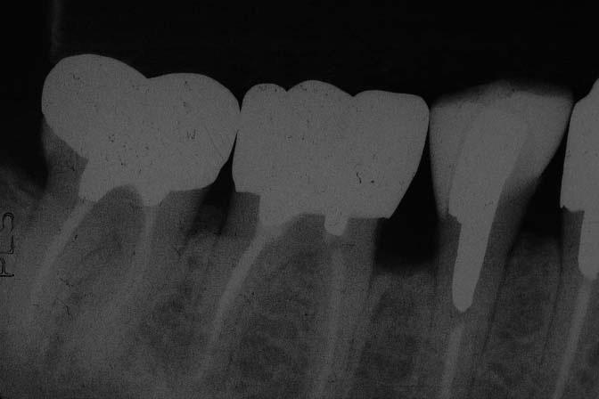 In addition, the premolar Estenia restoration did not grind the antagonists during the three-year observation period.