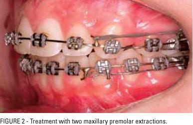 Clinical Considerations for Premolars Fehrenbach, MJ. Slide Collection. Single, permanent premolars can be extracted in each quadrant during orthodontic therapy to improve dental arch spacing.