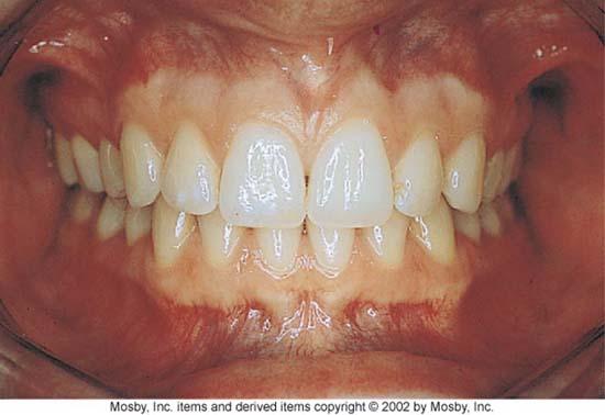 General Information ucrowns are shorter than the anterior teeth.