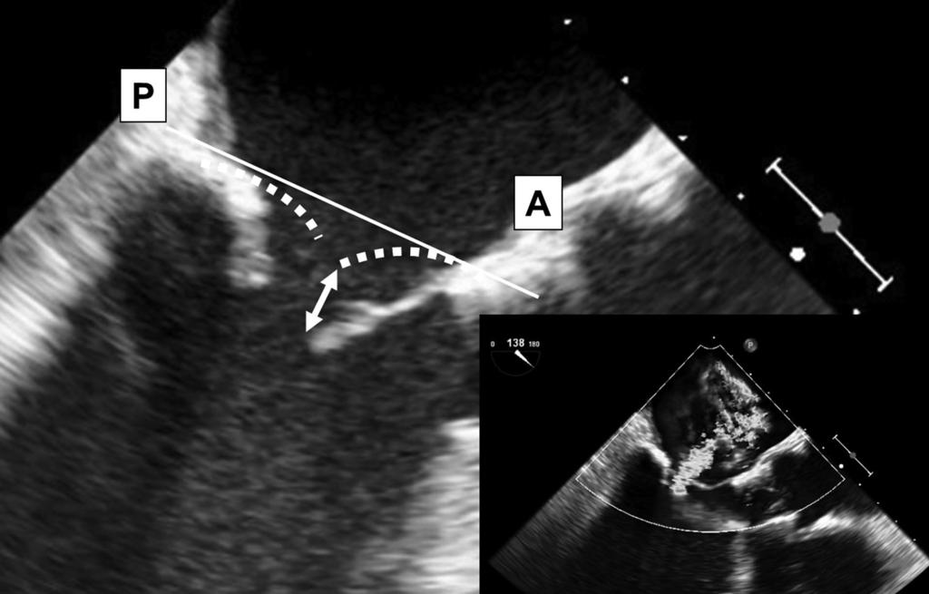 MitraClip for Severe Advance Publication by-j-stage Figure. Anterior mitral leaflet (AML) excursion.