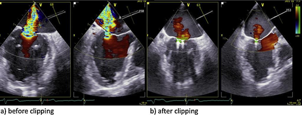 Simultaneous double MitraClip implantation 99 Figure 1 a and b) Transoesophageal echocardiography displaying significant mitral regurgitation before mitral clipping (left panel).