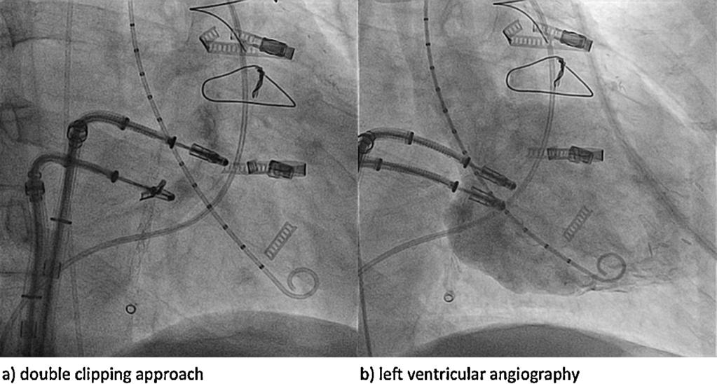 Left ventricular angiogram with no evidence of mitral regurgitation while both MitraClips are closed but still connected to the CDS (right panel).