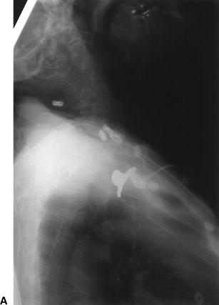 408 SEMINARS IN RESPIRATORY AND CRITICAL CARE MEDICINE/VOLUME 25, NUMBER 4 2004 Figure 2 (A) Lateral radiograph revealing a foreign body (dental prosthesis) in the midtrachea.