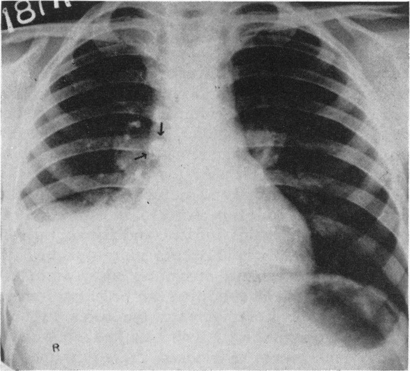 . 1 Not x-rayed before bronchoscopy which 9 were children.