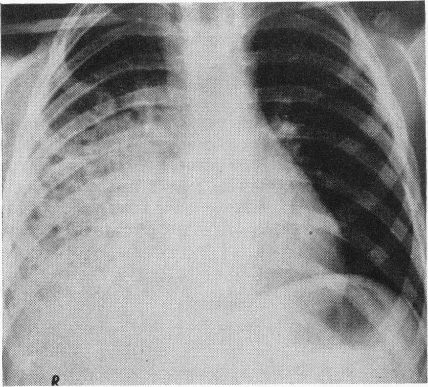 FIG. 5.-Boy, aged 3 years and 6 months, who was admitted with a diagnosis of pneumonia. The radiograph shows extensive consolidation involving the right middle and lower lobes.