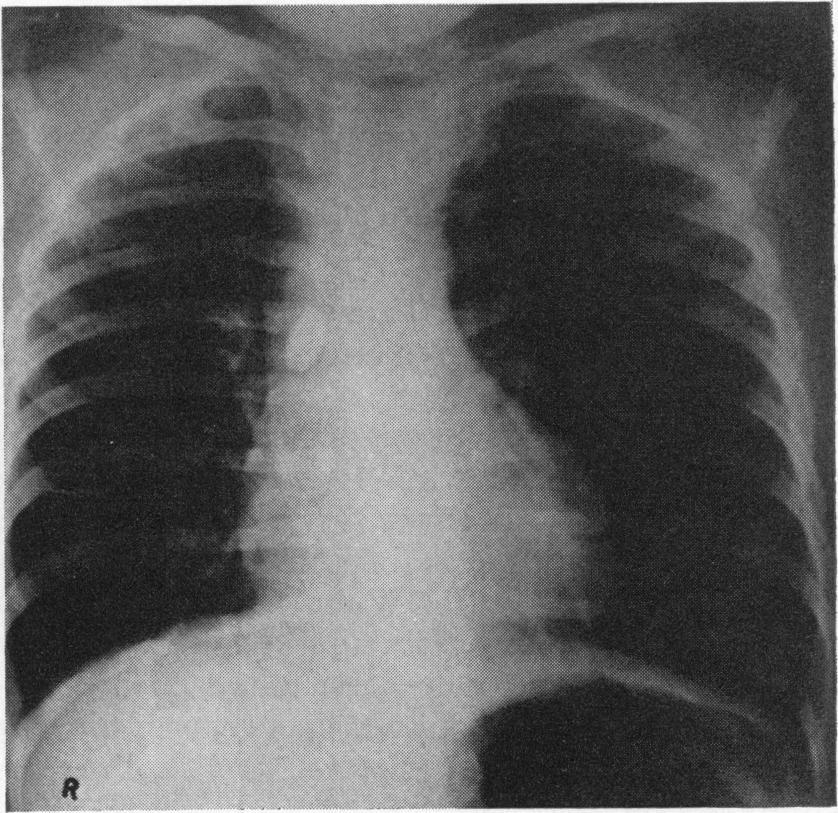 The opaque bead is shown in the right main bronchus, but the lung fields are clear and if the foreign body had been non-opaque the diagnosis would have been missed. (a) (b) FIG. 6.