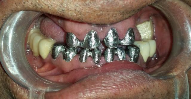5: Tooth preparation Fig.6: Definitive Impression Fig.