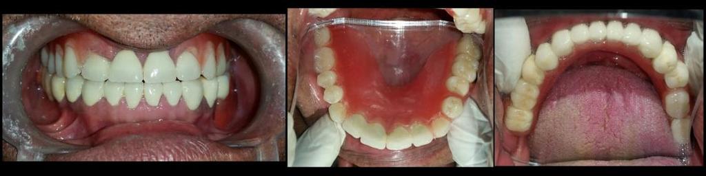 On the master cast, record base and occlusal rims were fabricated and jaw relations were recorded. Teeth setting and trial was then done followed by processing of the denture (Figure 9).