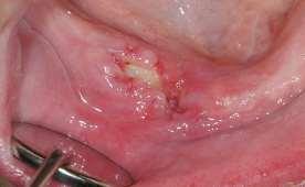 spread osteomyelitis Bisphosphonate-necrosis (BRONJ Bisphosphonate related ON of the Jaw) trauma