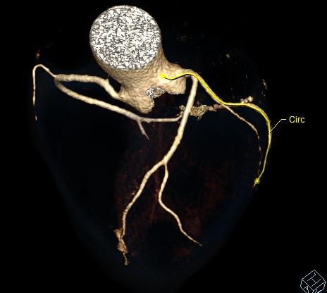 Cardiac CT Imaging Left: CCTA Syngo via