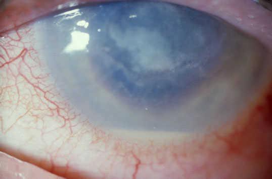 keratitis in contact lens users occurred in 2004-2006, related to loss of disinfecting capability of the ReNu contact lens solution, now withdrawn 18.