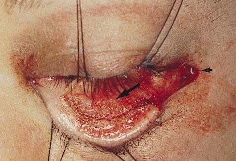 In preparation for the preseptal approach to the orbital floor, the surgeon stood at the head of the operating table and everted the patient s lower eyelid to view the inner aspect of the inferior