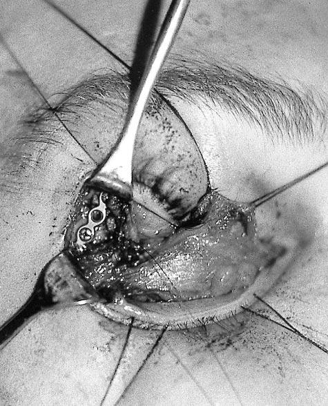 The third complication involved a technical error in suturing the lateral canthus too anteriorly, causing a slight separation of the lateral eyelid margin from the globe and accumulation of