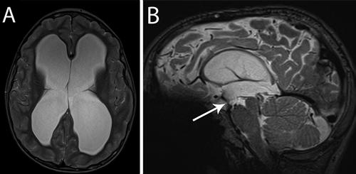 Failure of ETV FIG. 2. Case 2. A: Axial T2-weighted MRI demonstrates enlarged ventricles without transependymal flow.