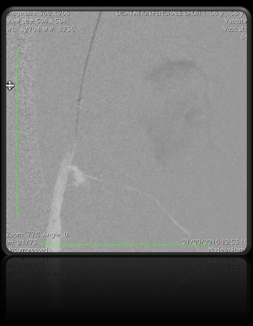 GUIDEWIRE PUSHED THROUGH THE POPLITEAL ARTERY