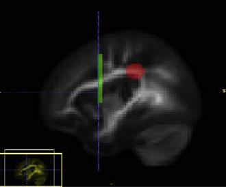 X. Geng et al. / NeuroImage 61 (2012) 542 557 555 Table A1 (continued) Arcuate Fasciculus Tract (Left and Right) The source ROI is placed at the white matter beneath the temporoparietal junction.