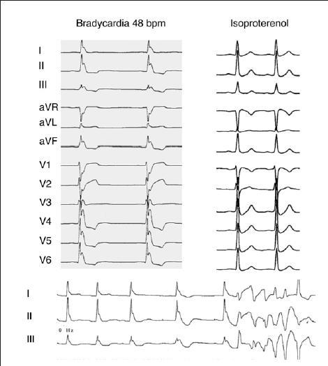 The Syndrome of infero-lateral early repolarization Cohort of 122 pts with idiopathic VF mean age 37 years Multiple VF episodes: 33 pts (27%) Electrical storm: 16pts (13%) No response to