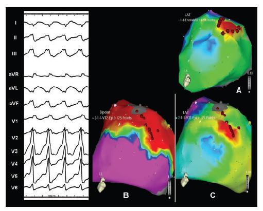 Endocardial and Epicardial mapping of a monomorphic VT endocardial