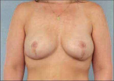 2% 3.6% Neuman H, et al. 2018 American Society of Breast Surgeons Annual Meeting. Abstract 403956.
