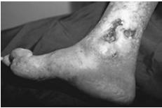 Diabetic foot ulcer Arterial ulcer 5 Pressure ulcer Venous ulcer Hypothesis of chronic wound