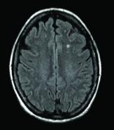 parkinsonism, gait abnormalities Basic Labs CMP, TSH, vitamin B12 (B1, B6) Brain Imaging