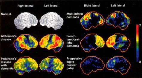 Functional Imaging FDG-PET Alzheimer s Disease Amyloid Plaques