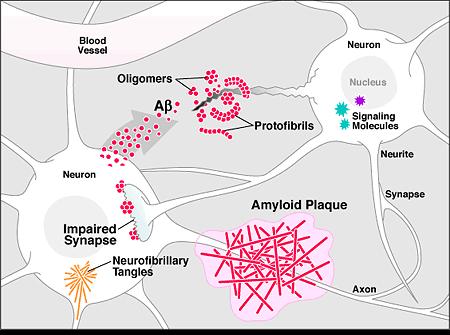 Ab 1-42 apoe e4 Plaque formation Neurofibrillary
