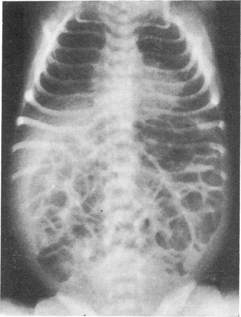 In 4 babies with bile-stained vomit, incomplete small bowel obstruction was excluded by x-ray examination after a barium meal which was followed through.