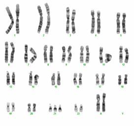 Summary of Chromosome Anomalies Change in number e.g. trisomy 21 Down syndrome; Edwards syndrome; Turner syndrome.