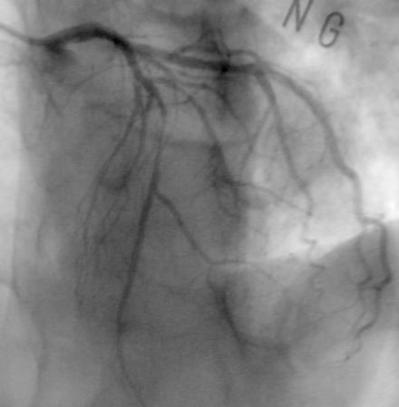 Coronary Artery Plaque