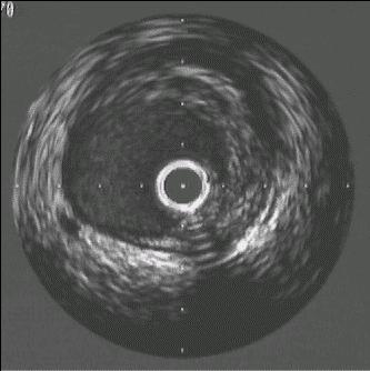 Intravascular US Shows Noncalcified