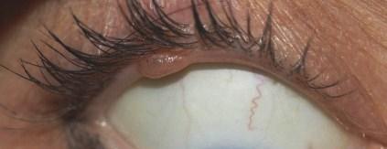 [9] All three cses were present over upper eyelid nd ptients were from the 4 th decde. Cliniclly, it involves ny prt of eyelid skin nd presents s flt or elevted, usully pigmented lesion.