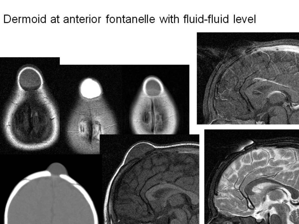 Fig. 6: Dermoid at anterior fontanele with fluid-fluid level