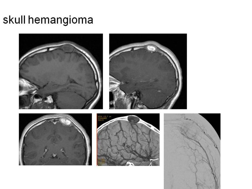 Fig. 26: Hemangioma Pediatric neuroradiology,