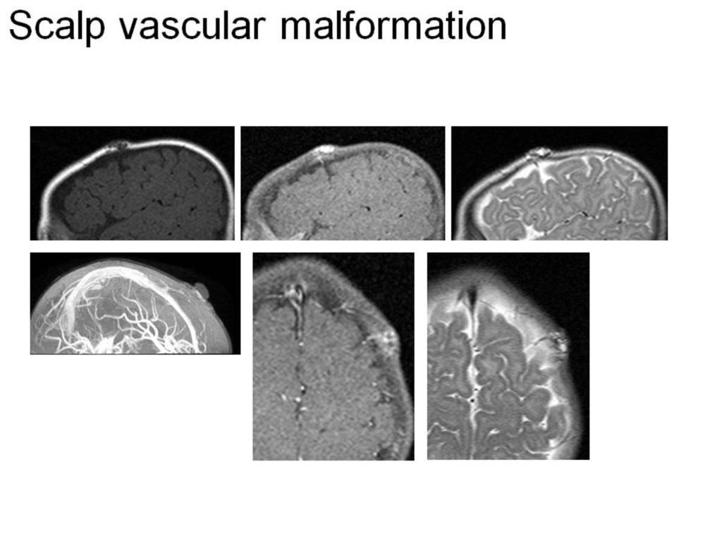 Fig. 25: Scalp vascular malformation Pediatric