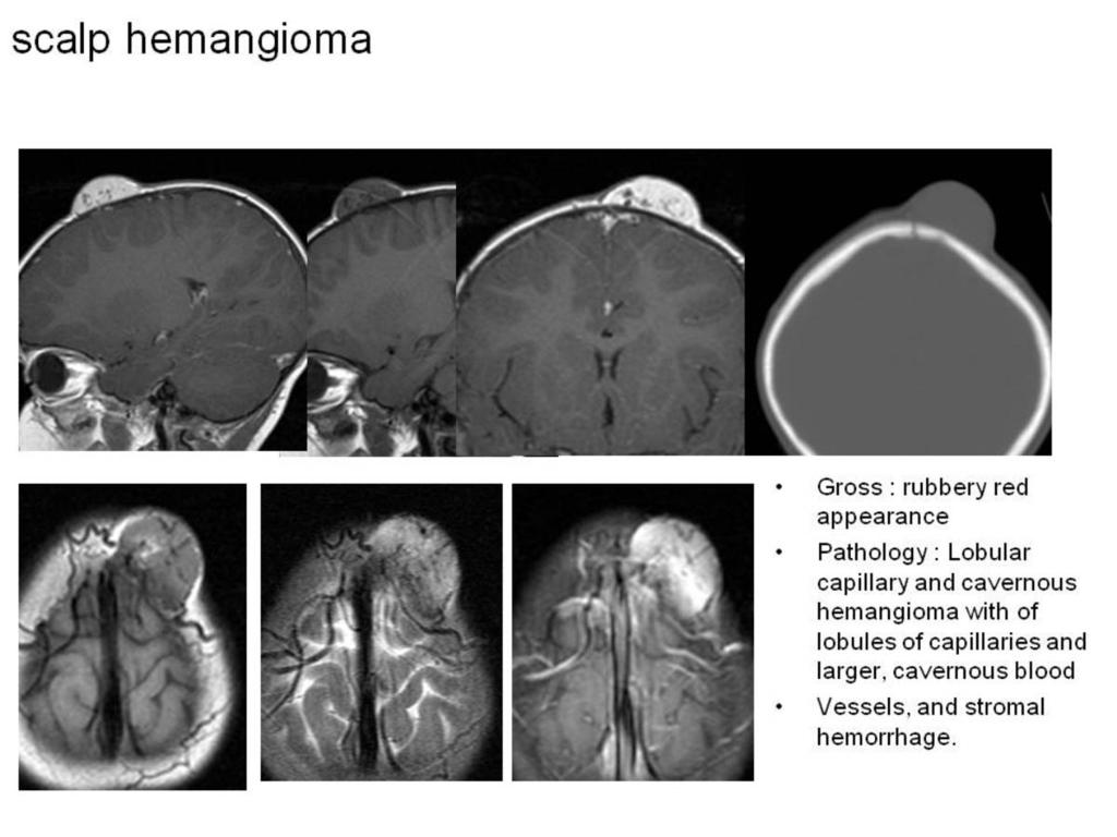 Fig. 24: Scalp hemangioma Pediatric