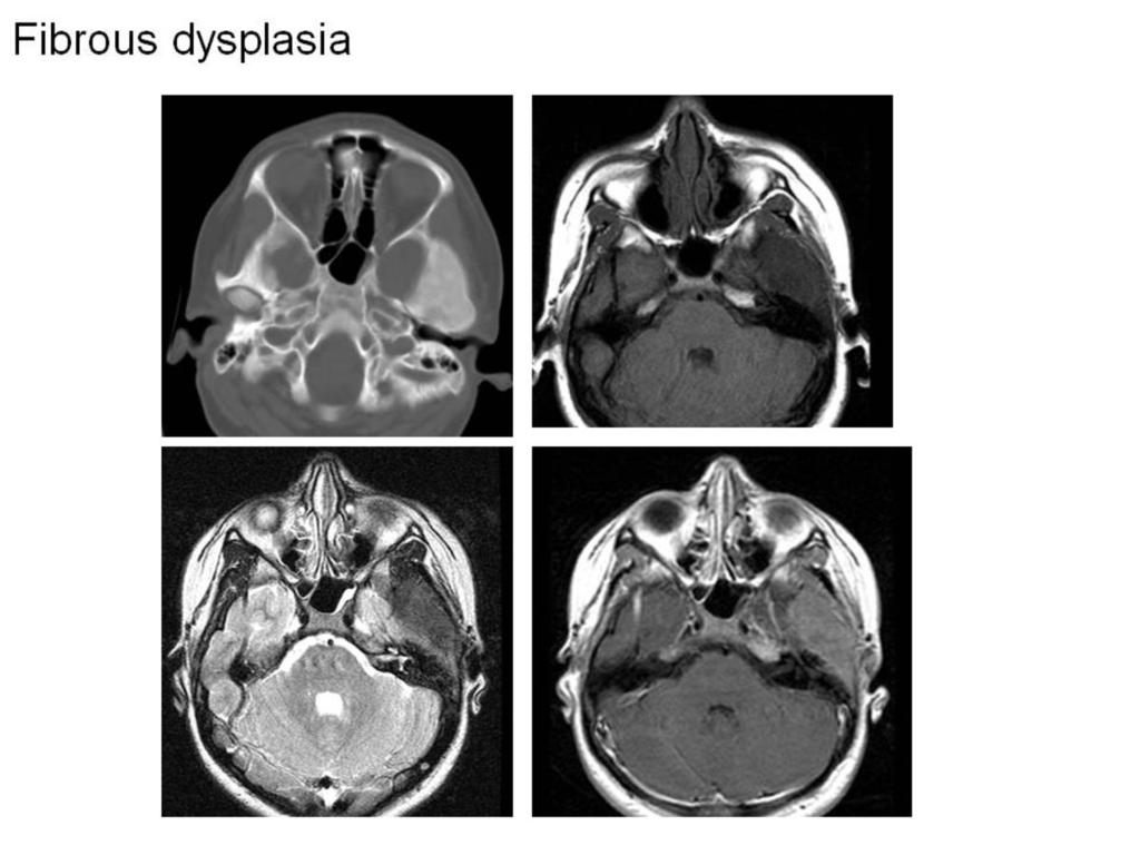 Fig. 37: Fibrous dysplasia