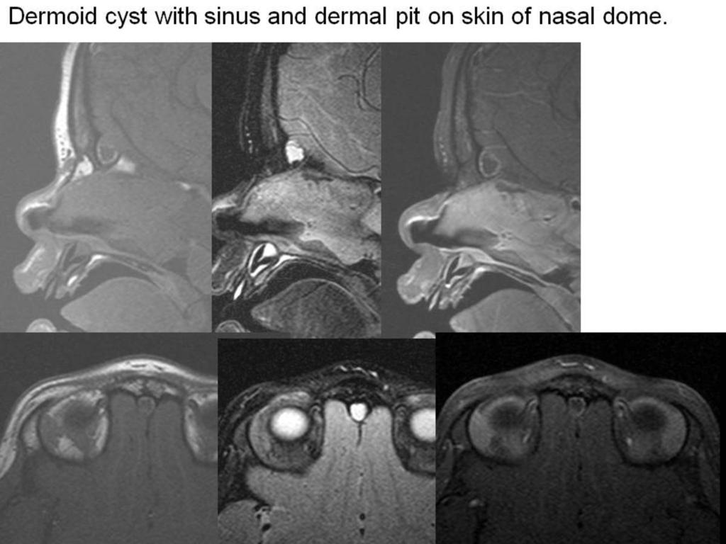 Fig. 11: Dermoid with dermal pit and sinus Pediatric