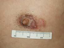 Cutaneous B-cell hyperplasias Aka lymphocytoma cutis Clinical: Flesh colored to plum-red subcutaneous nodules and plaques similar to CBCLs Face, chest and upper extremities Female to male ratio is