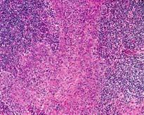 Small cell melanoma Cutaneous lymphadenoma