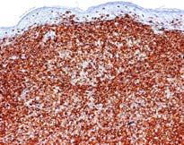 s cell) Leukemic deposits Mastocytosis