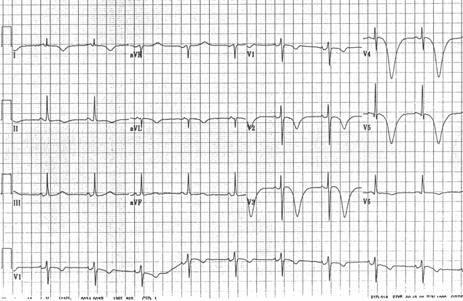 Brugada Syndrome Brugada Abnormality is defined as RBBB with ST elevation and occurrence of sudden cardiac death or syncope due to polymorphous VT (1990) Hereditary bundle branch defect Autosomal