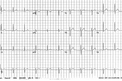 Normal Intervals & Axes PR 0.12 to 0.21 sec QRS - < 0.10; 0.11 to 0.12 incomplete IVCD; abnormal > 0.12 sec QT c < 0.