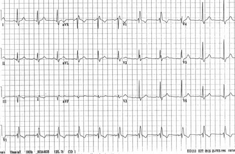 Acute Pericarditis 45 yo woman with nausea and vomiting RBBB Which of the following is not true about RBBB? A. RBBB occurs in up to 29% of AMI B.