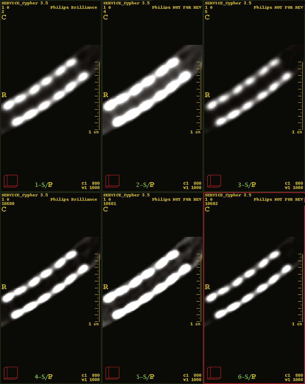 HALPERN ET AL Academic Radiology, Vol -, No-, - 2009 Figure 2. Multiphase display of a 3.5-mm stent that was imaged in an oblique orientation to the scan plane.