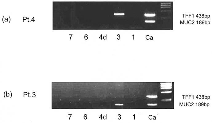 414 SONODA et al: DETECTING EARLY GASTRIC CANCER MICROMETASTASES Figure 1. (a) Representative results for a TFF1-positive/MUC2-negative case. (b) A TFF1-negative/MUC2-positive case.