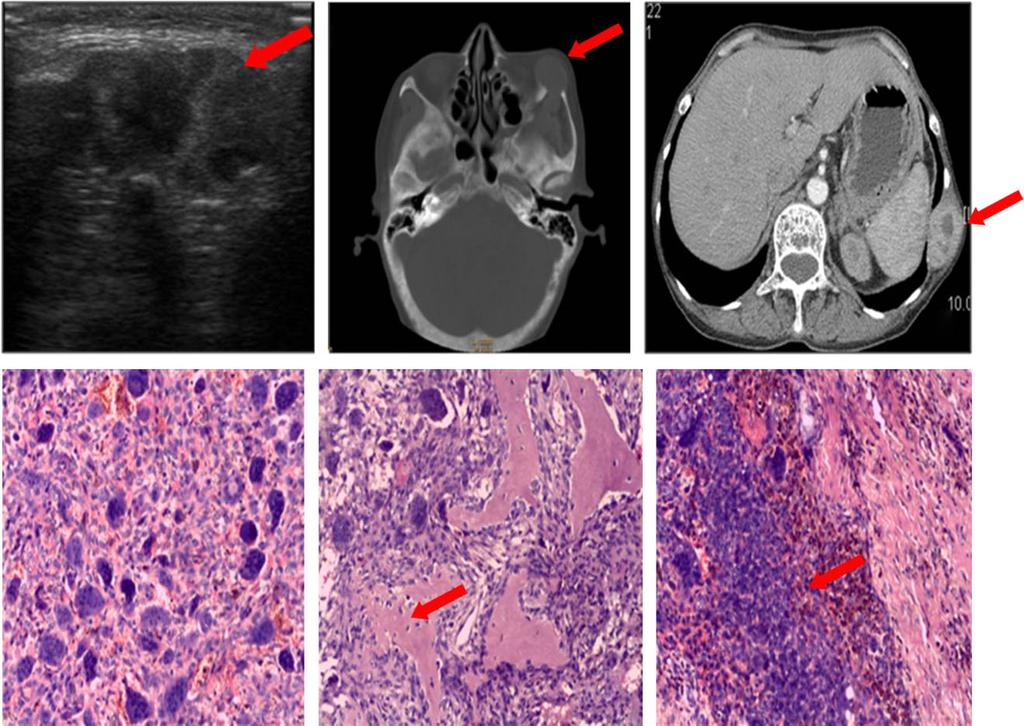J. Zhang et al. Hyperparathyroidism with brown tumor Table 1 Laboratory findings of the three cases Case Ca (mmol/l) P (mmol/l) ALP (IU/L) PTH (pmol/l) 24hUCa (mg) 1# 2.94 0.81 732 >263 399.6 2# 2.