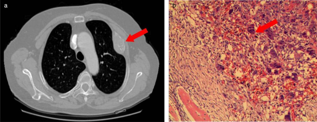 Hyperparathyroidism with brown tumor J. Zhang et al. Figure 2 (a) Chest computed tomography (CT) reveals many local lesions in the left 3rd rib and a local soft tissue mass has formed.