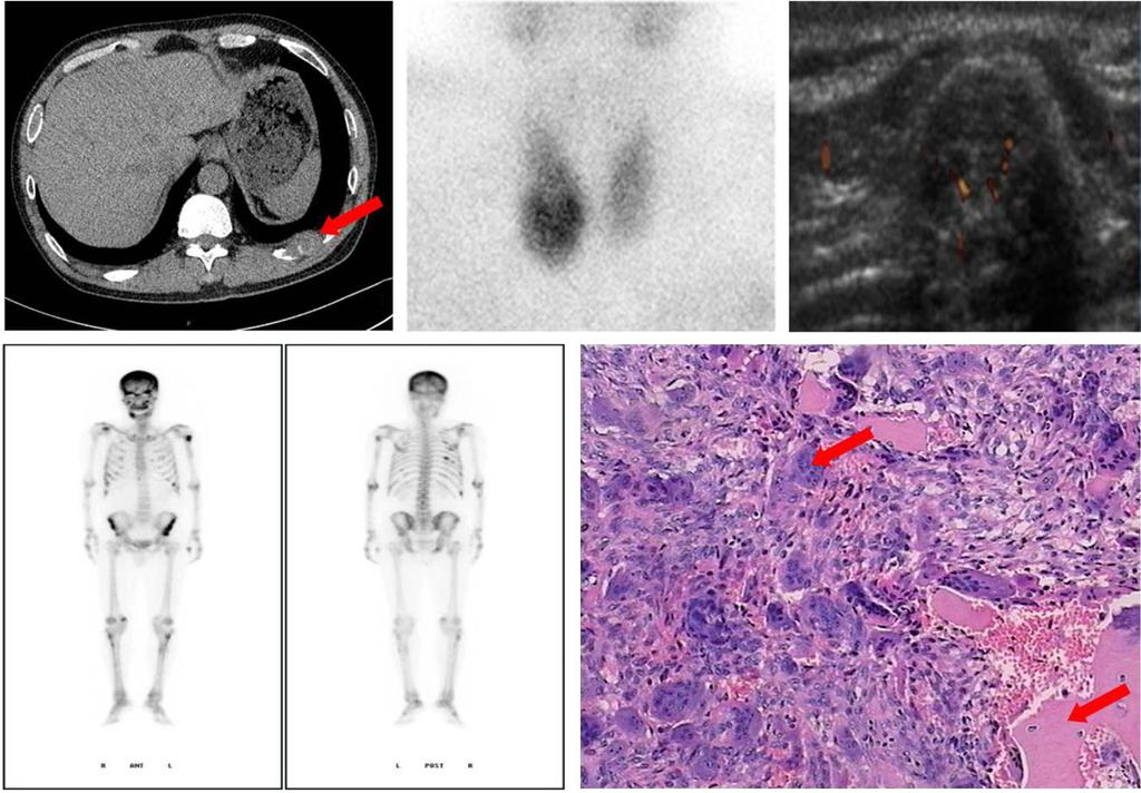 J. Zhang et al. Hyperparathyroidism with brown tumor a b c d e Figure 3 (a) Chest computed tomography (CT) reveals many local lesions in the left 11th rib and a local soft tissue mass has formed.
