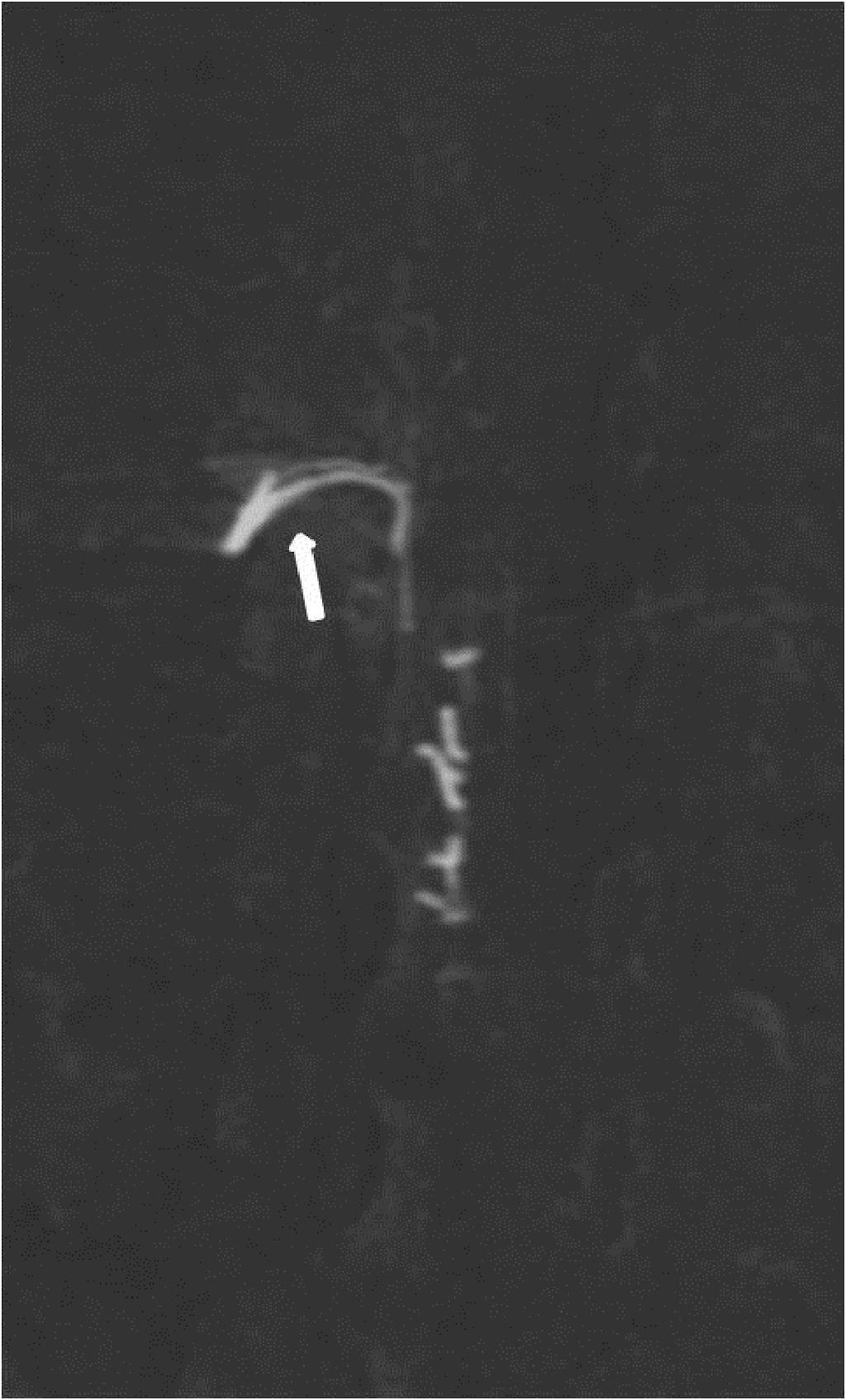 FIGURE 8: Case 2 MIP image depicts the origin of this thin artery, which originates from a much more proximal point (arrow)